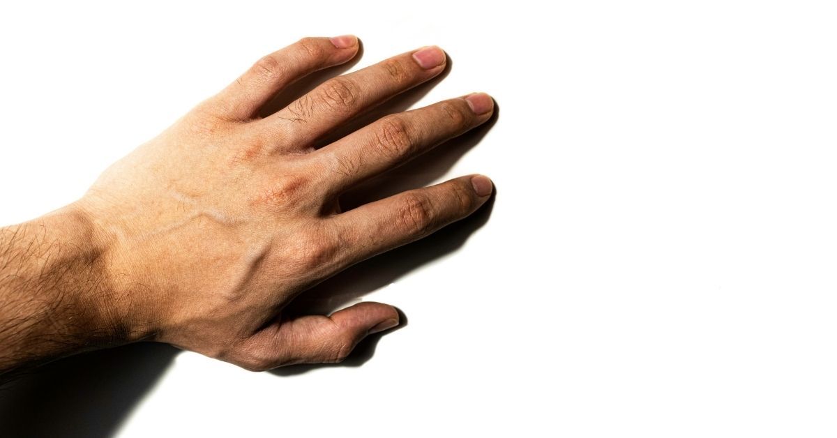 Artrite reumatoide.jpg