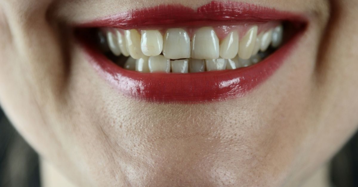 Danni sui denti dell'anoressia e bulimia