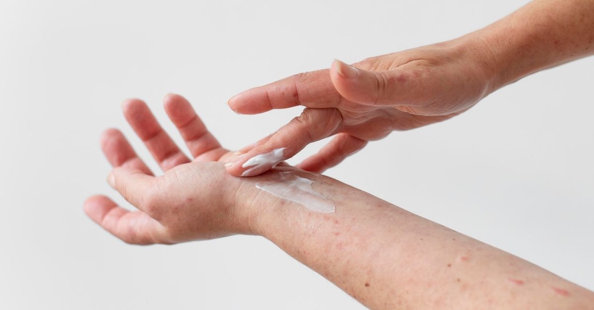 Rimedi per la dermatite da stress.